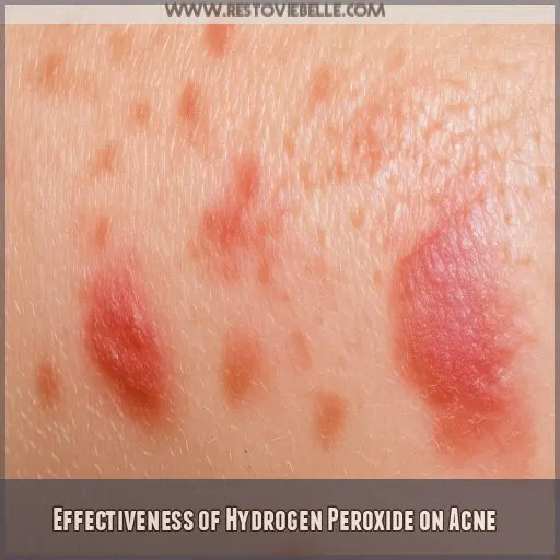 Effectiveness of Hydrogen Peroxide on Acne