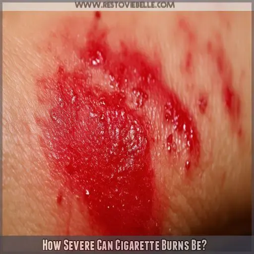 How Severe Can Cigarette Burns Be