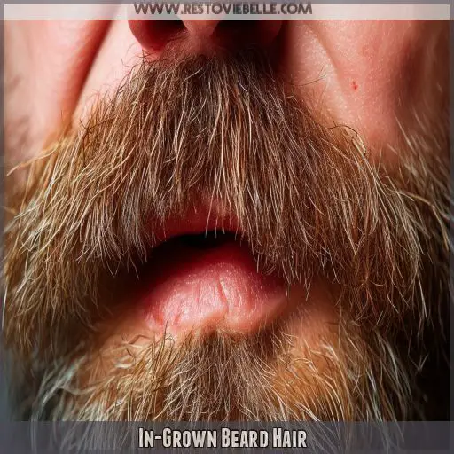 In-Grown Beard Hair