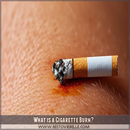 What is a Cigarette Burn