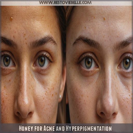 Honey for Acne and Hyperpigmentation