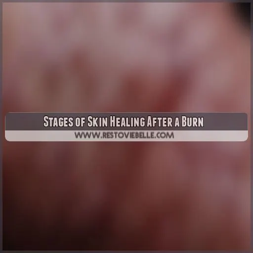 Stages of Skin Healing After a Burn