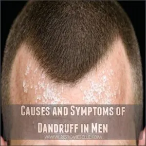 Causes and Symptoms of Dandruff in Men