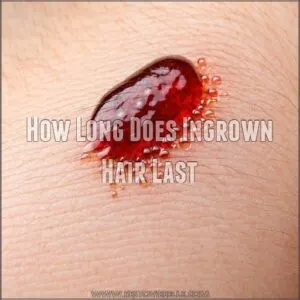 How Long Does Ingrown Hair Last